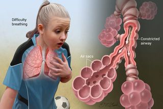 Preventing Asthma