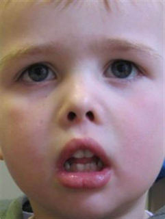 Mouth-breathing epidemic