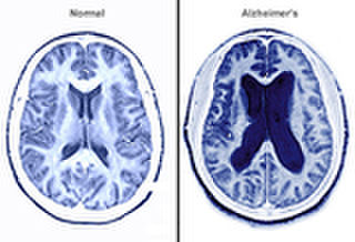 Study finds that sleep apnoea and Alzheimer's are linked