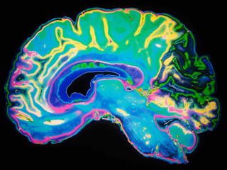 Hay fever drugs could increase risk of dementia and Alzheimer's
