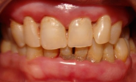 Periodontal Disease