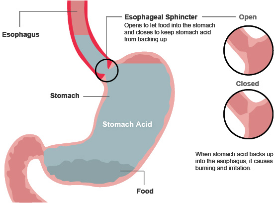 Gastric Reflux - Buteyko Breathing Clinics