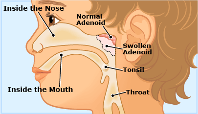 Help for Adenoids and Tonsils